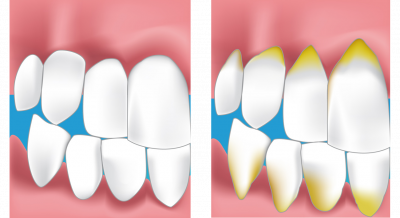 parodontie dentaire romainville